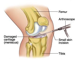 Arthroscopic Meniscus Repair
