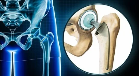 hip replacement surgery in Ghaziabad