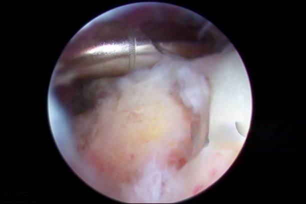 Arthroscopic Subacromial Decompression