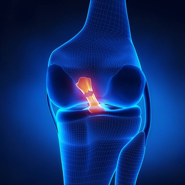 Arthroscopic ACL Reconstruction