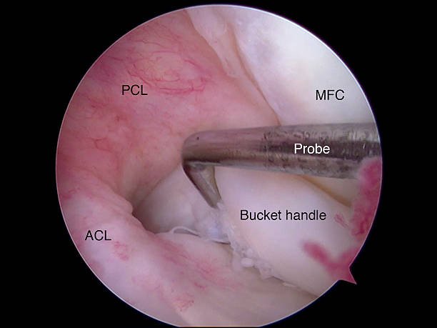 Arthroscopic PCL Reconstruction