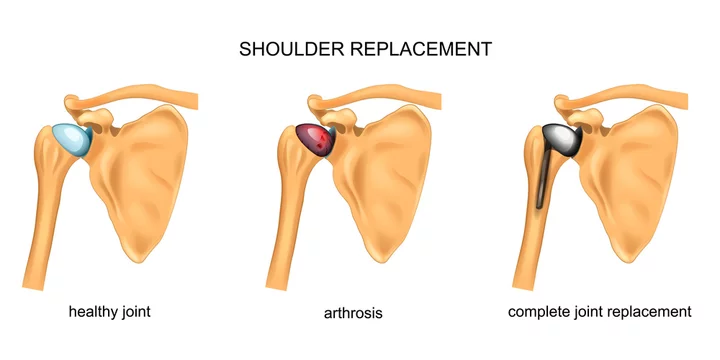 Shoulder Replacement Surgery in Indirapuram