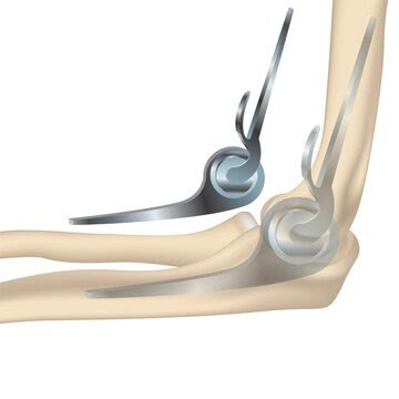 Elbow Replacement Surgery in Indirapuram