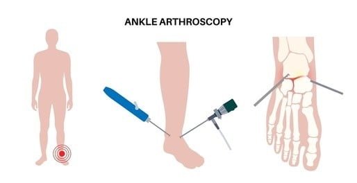 Ankle Arthroscopy Surgery in Indirapuram