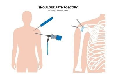 Shoulder Arthroscopy Surgery in Indirapuram