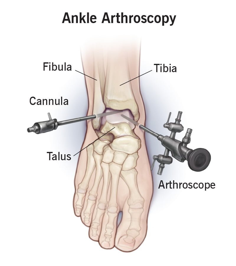 Ankle Arthroscopy Surgery in Ghaziabad