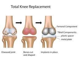 Knee Replacement Surgery in Vasundhara