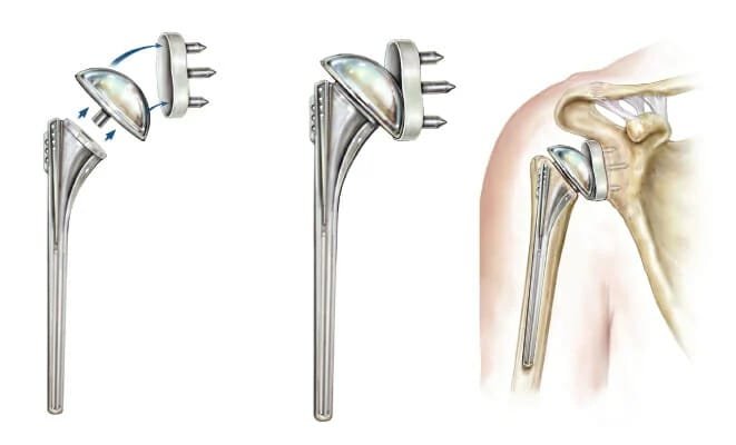Shoulder Replacement Surgery in Noida