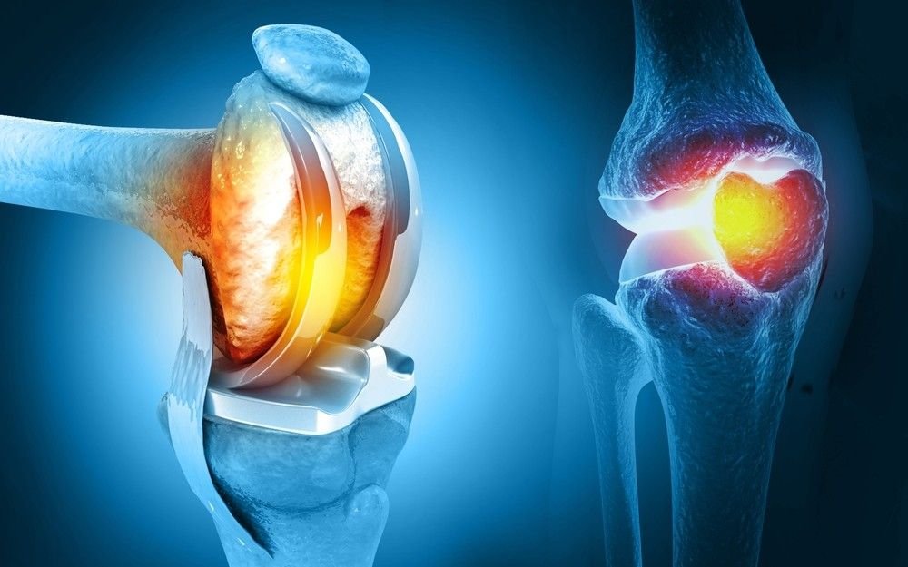 Best Knee Replacement Surgeon in East Delhi