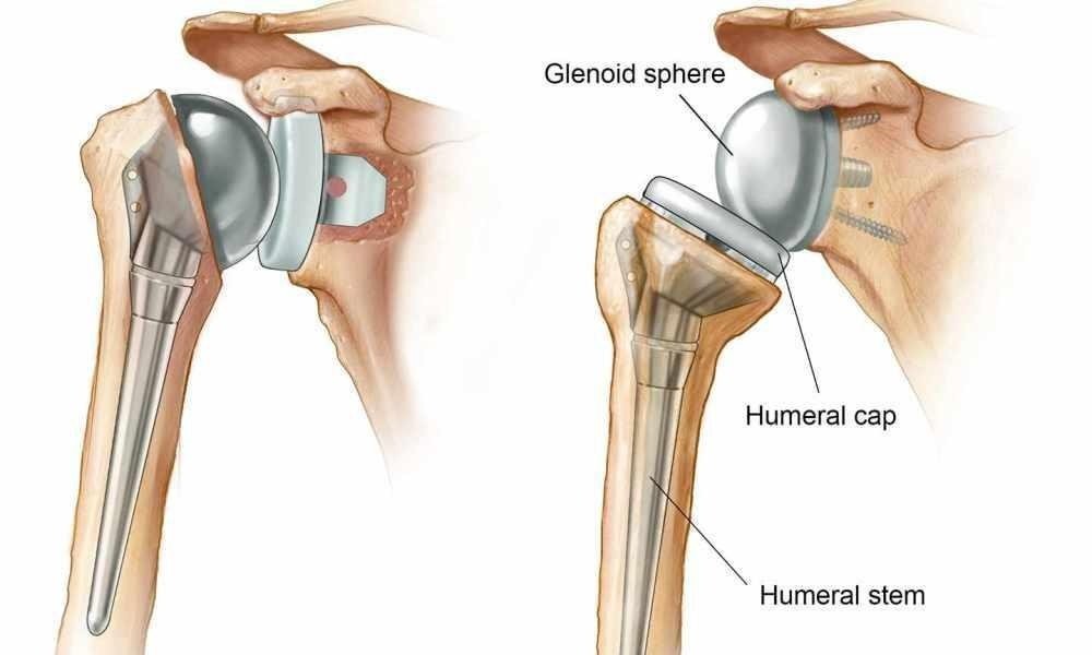 Best Shoulder Replacement Doctor in Noida