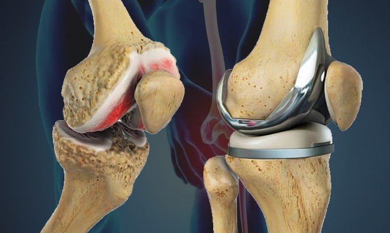 Best Knee Replacement Doctor in Ghaziabad